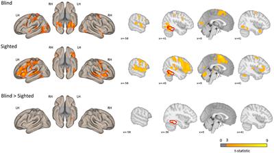 The role of the left ventral occipitotemporal cortex in speech processing—The influence of visual deprivation